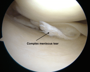 Complex Torn Meniscus Doctor Harrison NY