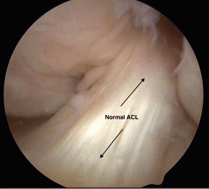 Normal ACL Tear Westchester County NY