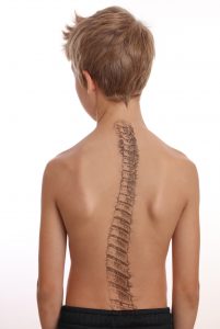 The backside of a young boy with Scoliosis Spine Curvature issues. He is shirtless wearing black trousers.
