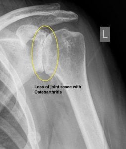 osteoarthritis of the shoulder
