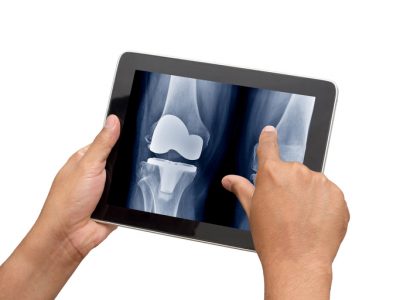 Doctor using tablet to check xray image of total knee replacement