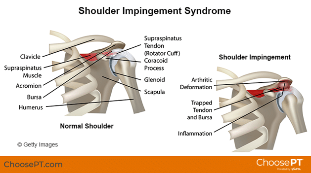 Why Does My Shoulder Hurt Specialty Orthopaedics