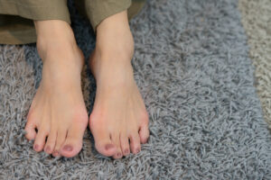 Bare feet with bunions