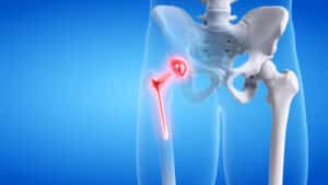 Illustration showing an artificial joint used in total hip replacement surgery, highlighting the replaced ball and socket of the hip